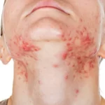 Simple Guide For People Wanting Clearer Skin Through Gentle Care Methods