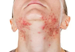 Simple Guide For People Wanting Clearer Skin Through Gentle Care Methods