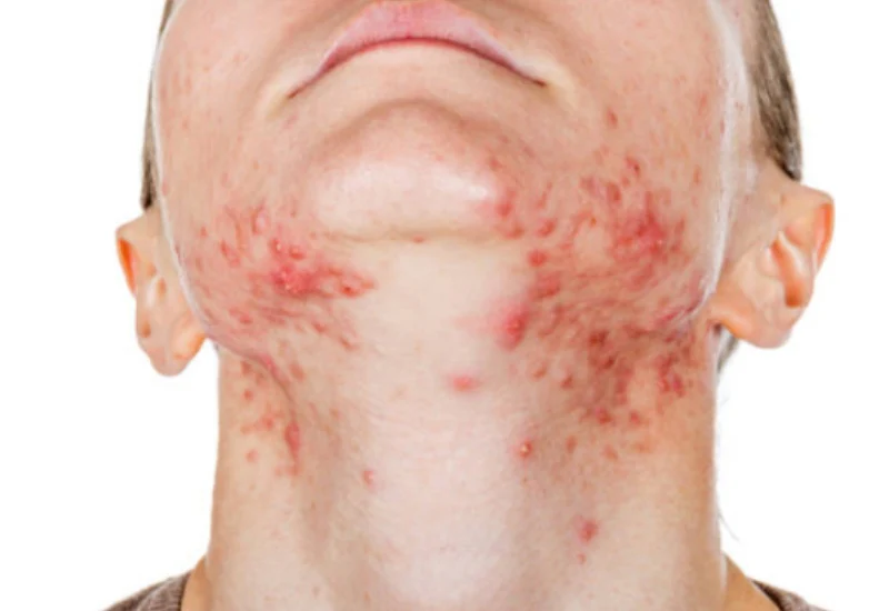 Simple Guide For People Wanting Clearer Skin Through Gentle Care Methods